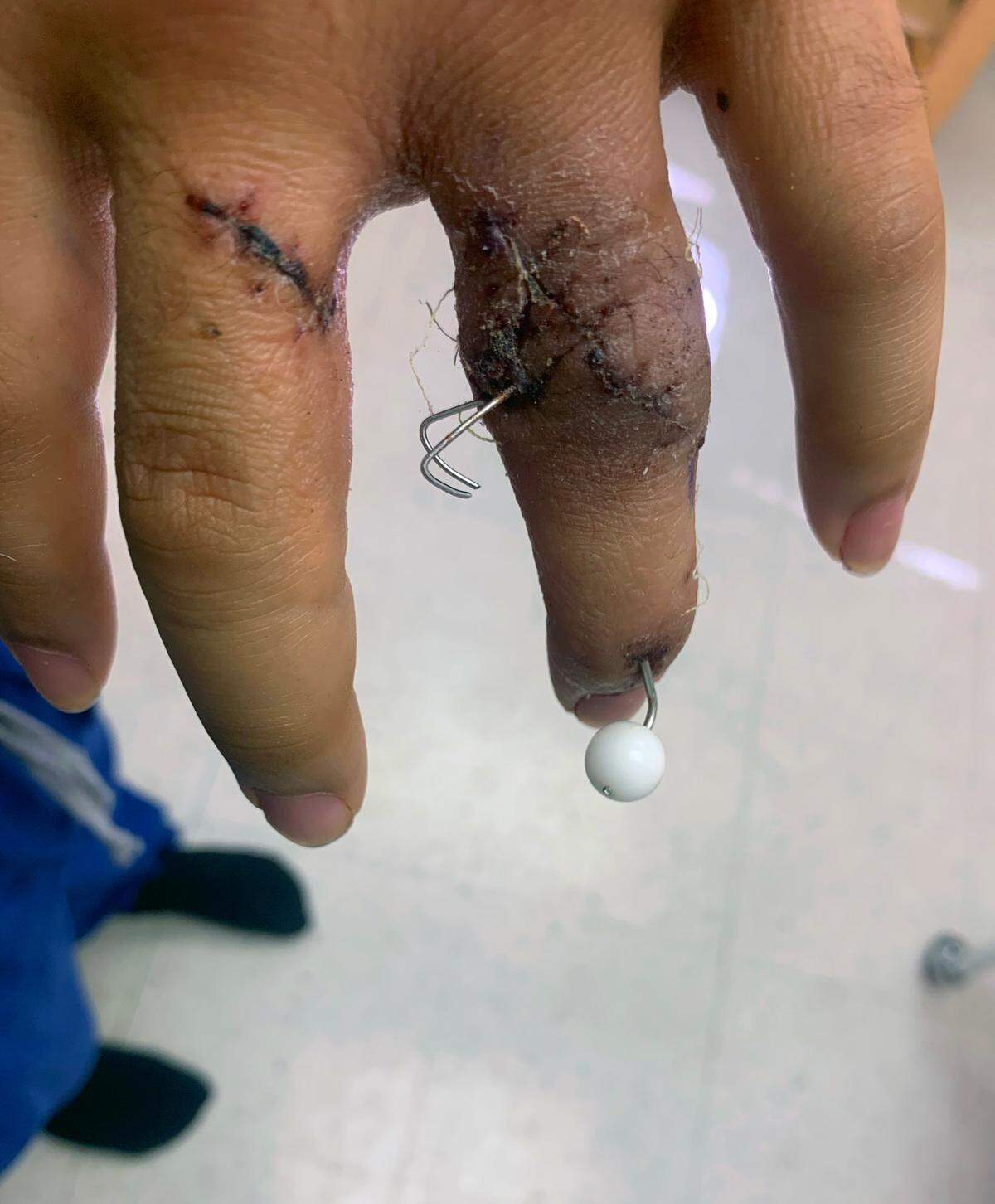 This photo shows the wounds to the hand of Jermaine Hernandez, who was shot after a traffic stop by Columbus police officers in February 2024.