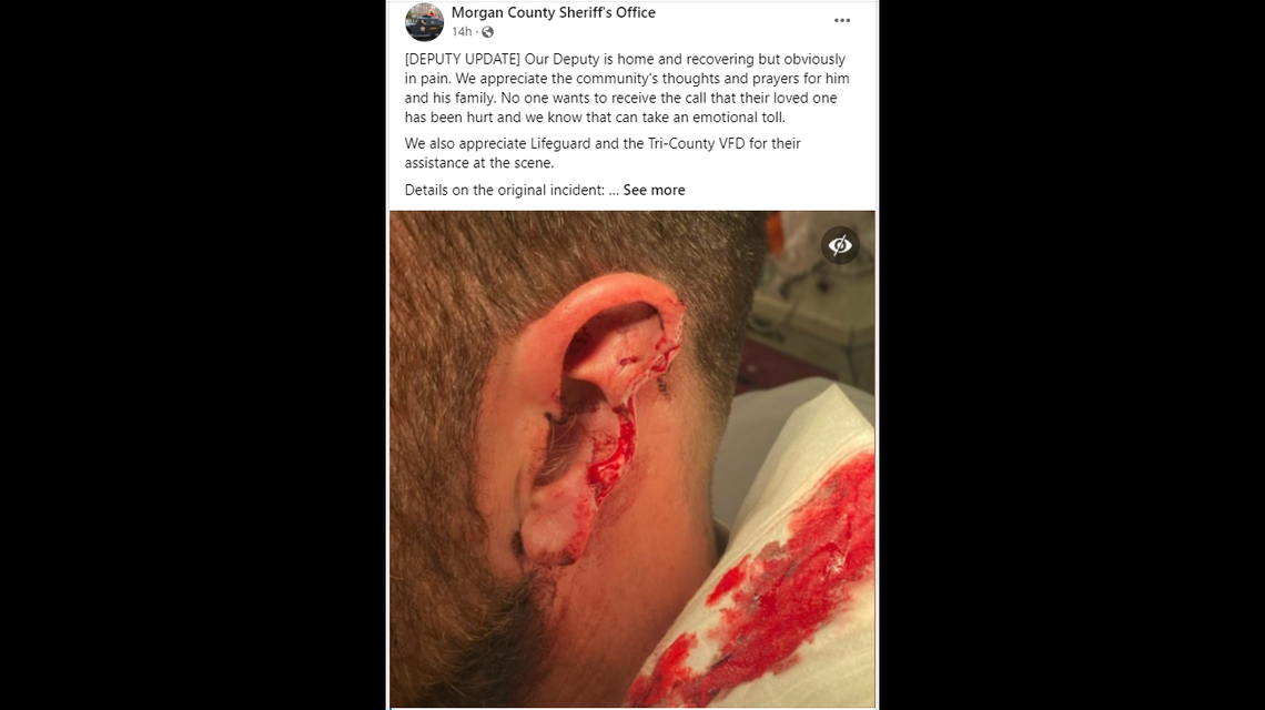 The Morgan County Sheriff’s Office in Alabama has shared graphic details after one of its deputies had his ear bitten and torn during a struggle.