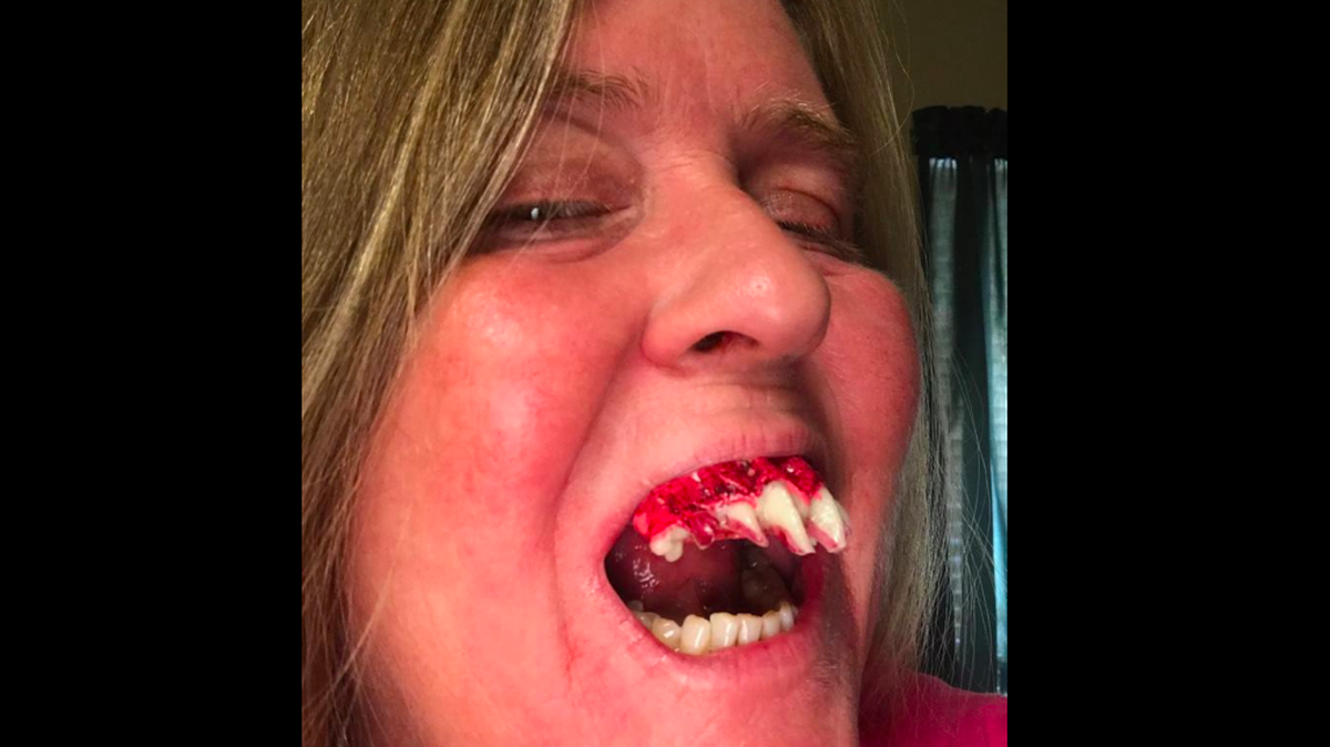 A Mobile, Alabama, woman is warning others after fake teeth fangs she bought for a costume at Walmart became painfully stuck in her mouth. She had to make an emergency appointment to get the teeth removed.