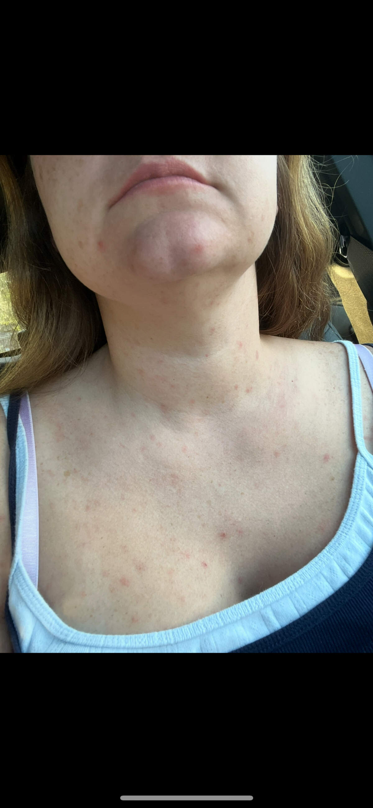 Leighann Morris, mother of three daughters, and wife of Sgt. Jeffrey Morris, was covered in hives after she said she was exposed to toxic mold in her HVAC cabinet while living on Fort Benning. She needed emergency room treatment after five weeks of skin conditions, she said.