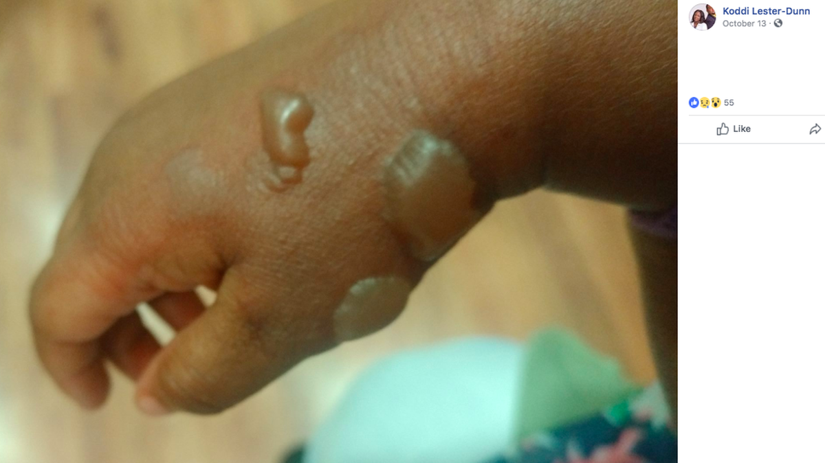A Lawrenceville Georgia family is warning of possible danger after they say their 2-year-old daughter got serious second-degree burns and blisters on her hand and arm from a hot Little Caesar’s pizza.