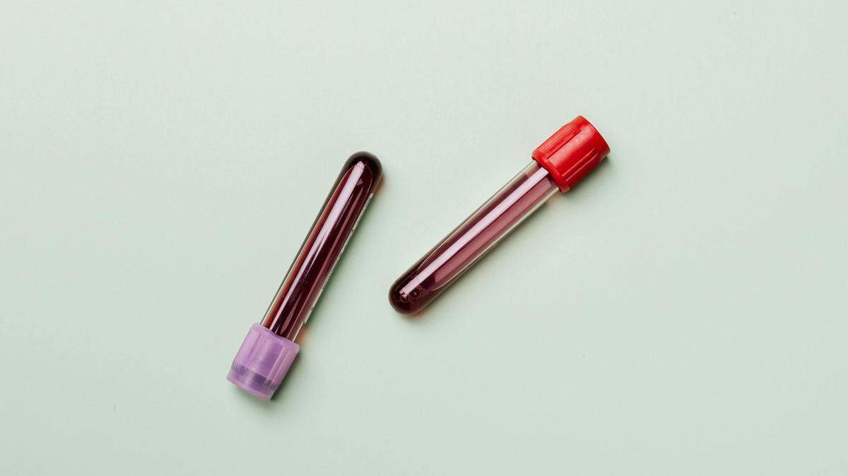 https://www.pexels.com/photo/blood-samples-4047146/