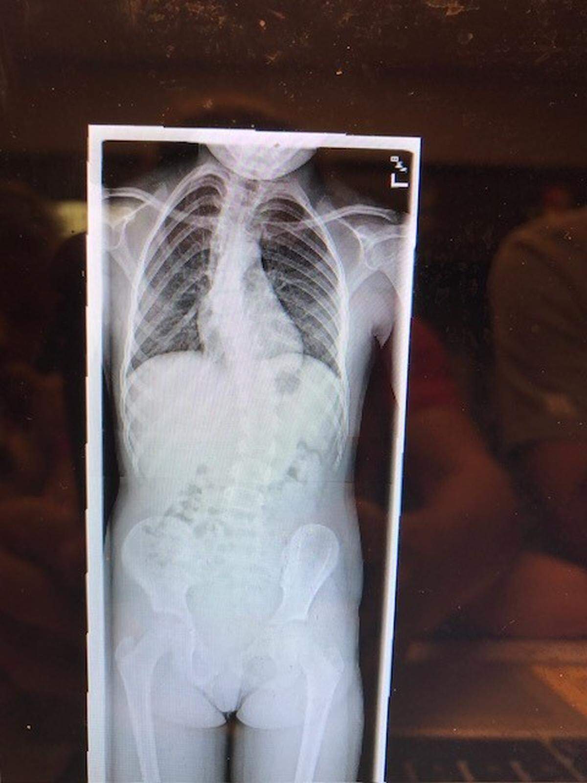 Harris County High School senior Effie Ward was diagnosed with scoliosis, a curved spine, while she was in elementary school.