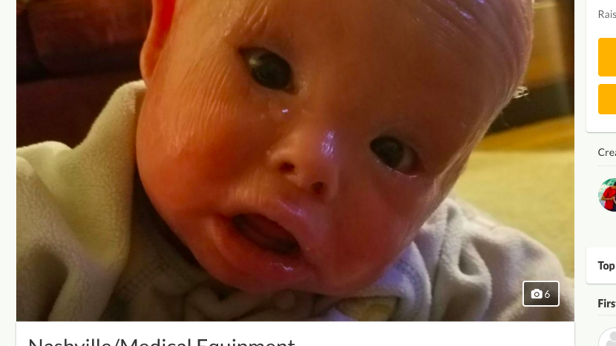 A mom has to give her baby Jamison baths in bleach solutions and rub off skin the child was born with Harlequin ichthyosis, a lifelong, terminal genetic disorder that causes plated, cracked skin and other abnormalities.